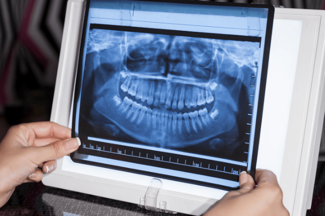 ¿Cuánta radiación recibo con una radiografía dental?