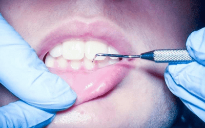 5 Motivos para hacerse la limpieza y una revisión dental anual
