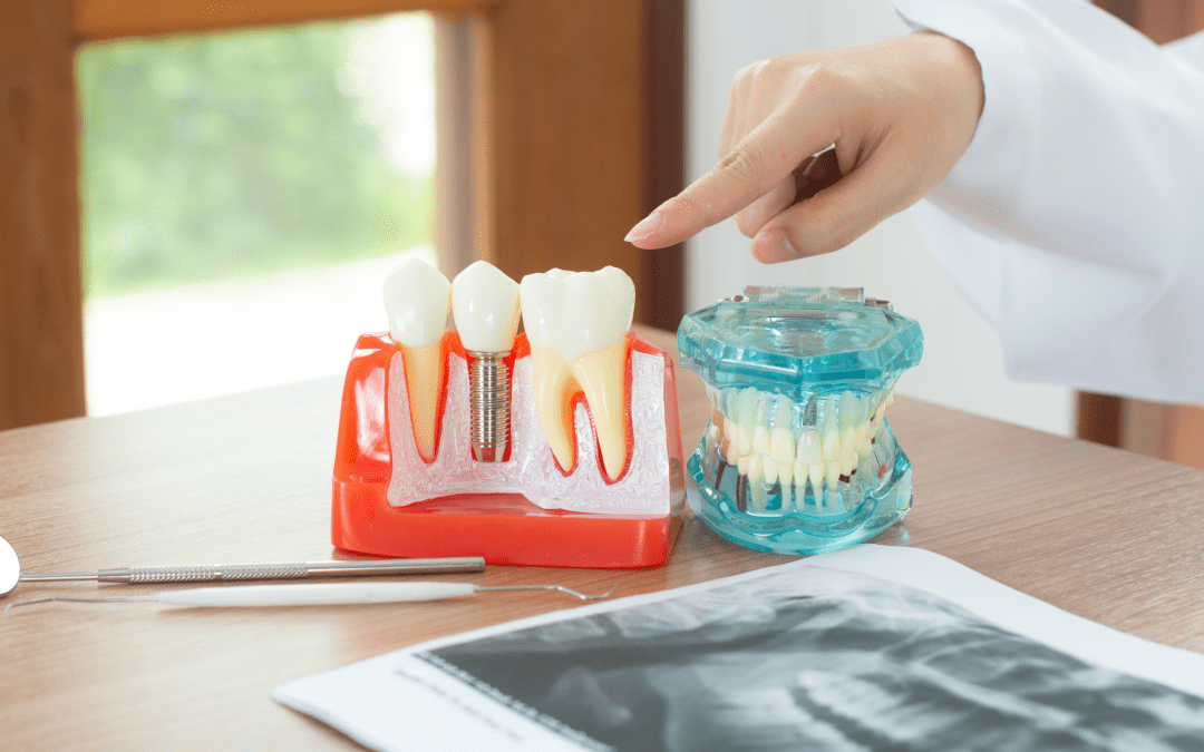 12 cosas que debo saber sobre los implantes dentales
