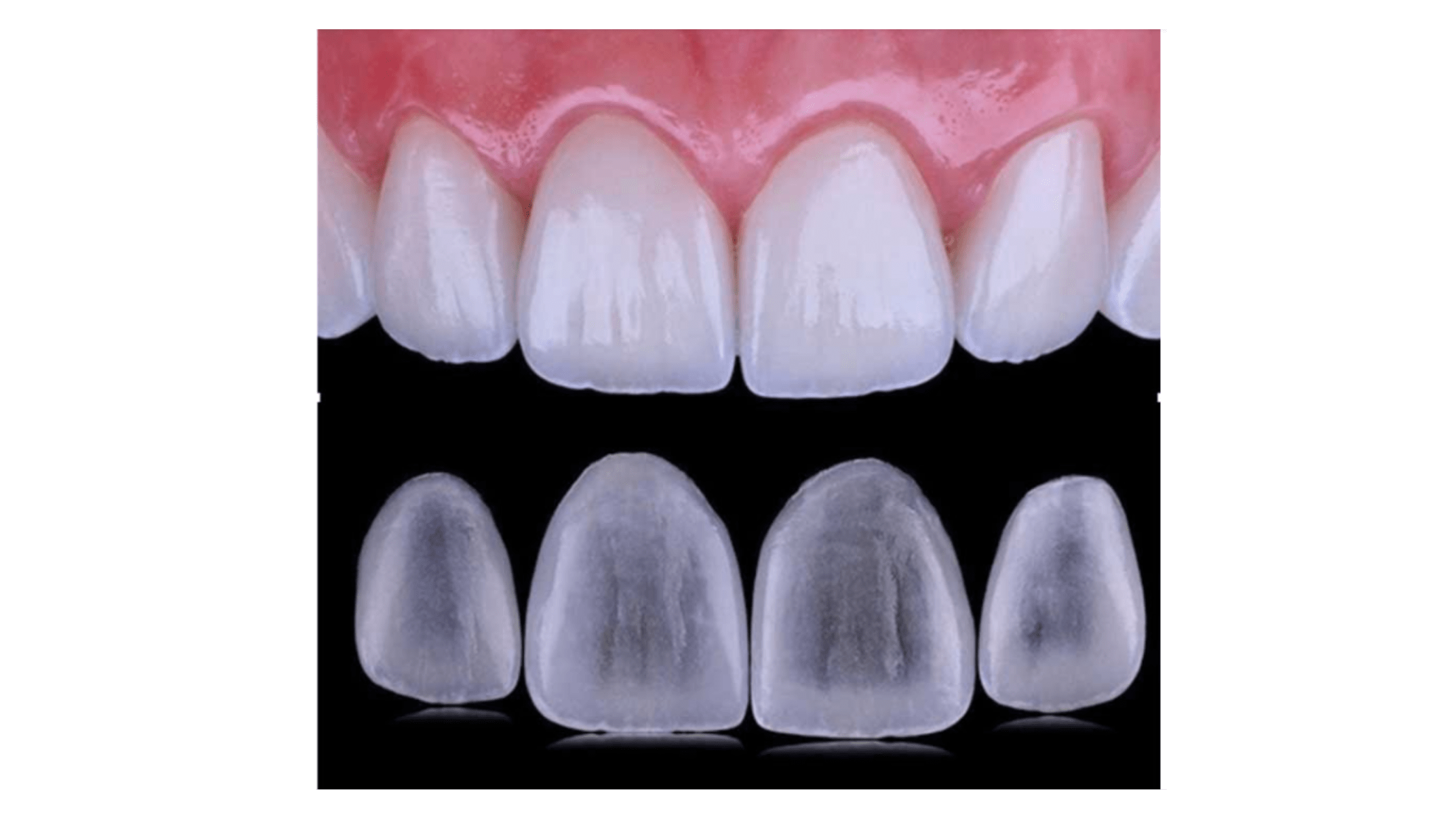 carillas dentales estetica dental dentalbaron