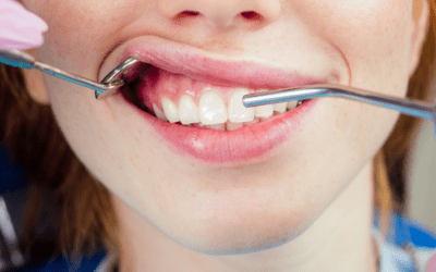 ¿Por qué salen manchas blancas en los dientes? y soluciones