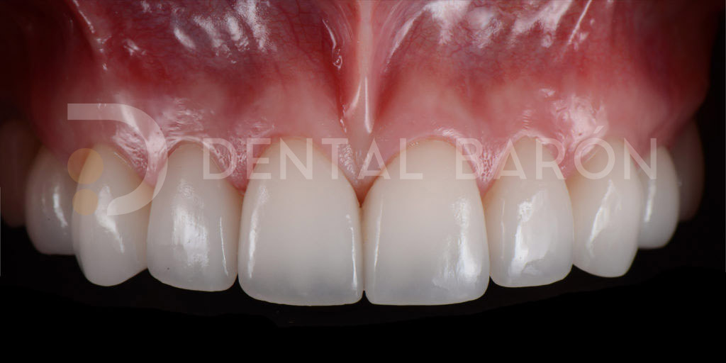 carillas dentales composite inyectado