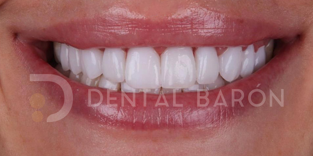 carillas dentales first fit